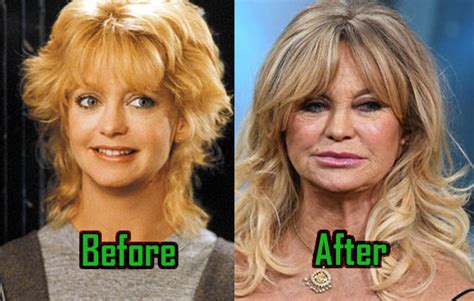 Goldie Hawn Plastic Surgery: Facelift, Injections, Before After ...