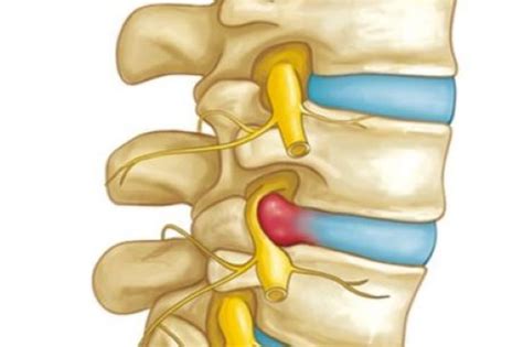 Herniated Disk in the Lower Back - OrthoInfo - AAOS