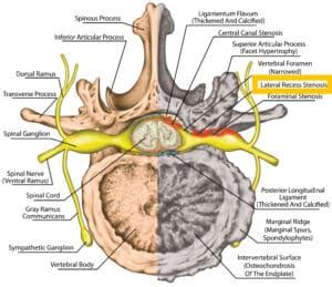 Lateral Recess Stenosis: Anatomy, Causes, Symptoms, Diagnosis, and Treatment - Spine Info