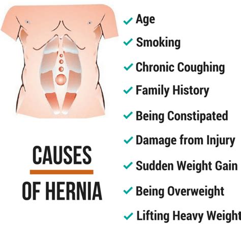 EVERYTHING YOU WANT TO KNOW ABOUT HERNIA - BIMS Hospital