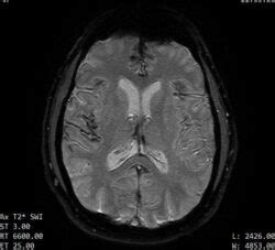 Decoding The Superficial Siderosis MRI – Living With Superficial Siderosis