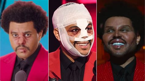 Is The Weeknd's Plastic Surgery Real? Photos, Details