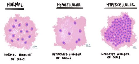 Hypocellular | Pathology dictionary | MyPathologyReport.ca