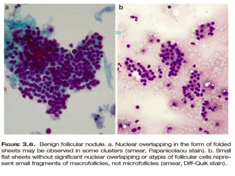 Bethesda System for thyroid cytopathology