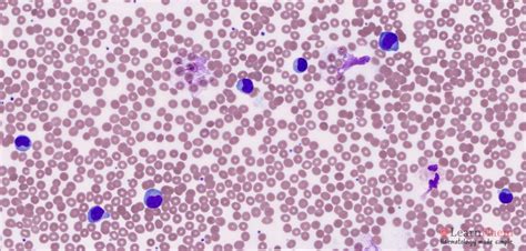 Reactive Lymphocytes / Benign Disorders - LearnHaem | Haematology Made Simple