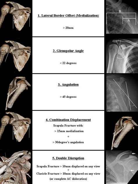 Treating Glenoid Fractures