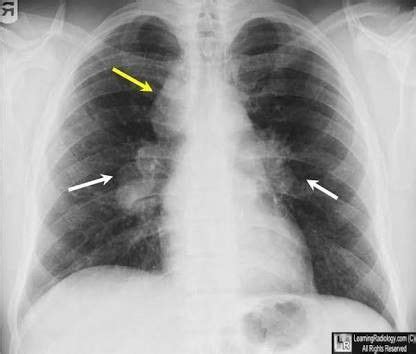 123 sign or garland sign (sacoidosis) Thorax, Pulmonary, Radiology ...