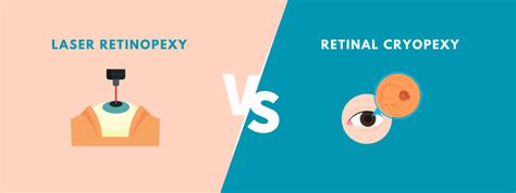 Laser Retinopexy vs Retinal Cryopexy | Buoy