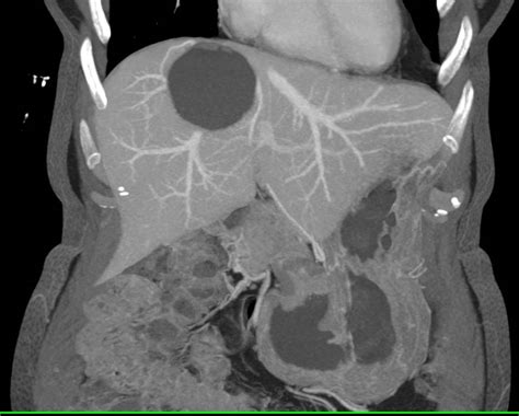 Simple Hepatic Cyst - Liver Case Studies - CTisus CT Scanning