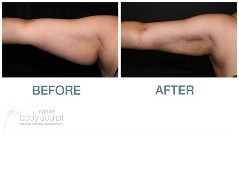 Laser Lipo | Natural Body Sculpt