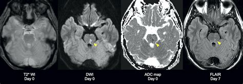 Internuclear Ophthalmoplegia Mri