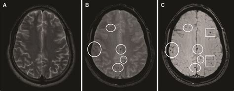 Current contribution of diffusion tensor imaging in the evaluation of diffuse axonal injury ...