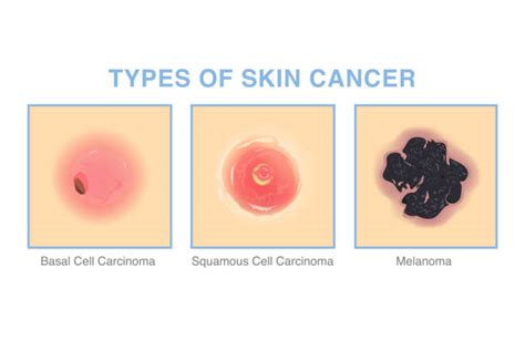 Types Of Skin Cancer Illustration About Medical Diagram Of Basal Cell Carcinoma Squamous Cell ...