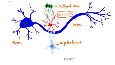 Pathology of Astrocytoma - Pathology Made Simple