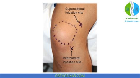 Knee Injection Technique - Easy Tutorial | OrthoFixar 2024