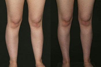 27 year old patient before and four months after cankles liposuction | Liposuction, Lymphatic ...