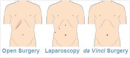 Laparoscopic Cholecystectomy Incisions