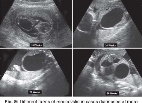 Figure 8 from Prune-belly Syndrome versus Posterior Urethral Valve ...