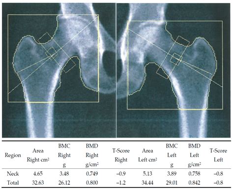 Diagnostics | Free Full-Text | Dual-energy X-ray Absorptiometry of Both ...