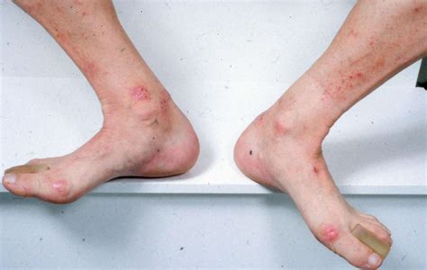 Dermatitis Herpetiformis (Celiac Disease Rash) Photos