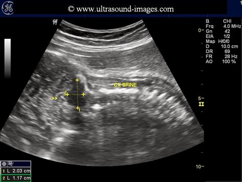 Ultrasound imaging: prominent fetal cisterna magna or more ominous?