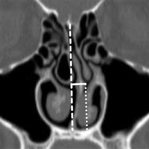 Figure 1 from The Impact of Middle Turbinate Concha Bullosa on the Severity of Inferior ...