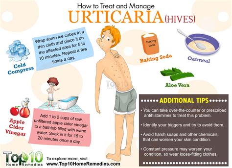 How to Treat and Manage Urticaria | Top 10 Home Remedies