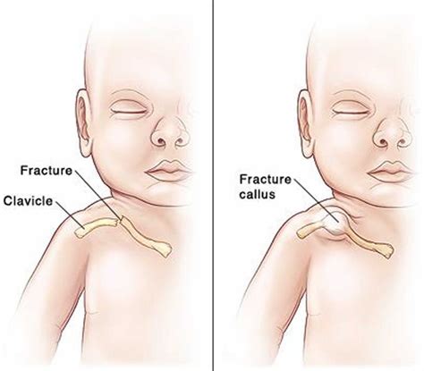 Birth injuries causes, signs, symptoms, diagnosis, treatment & prognosis