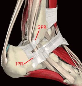 COSM | Peroneal tendon surgery