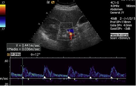 [PDF] Doppler ultrasound and renal artery stenosis: An overview. | Semantic Scholar