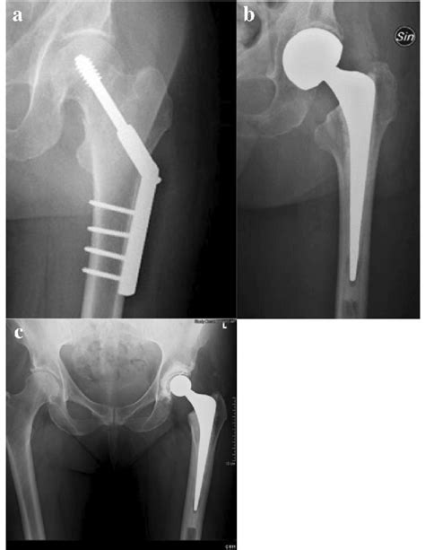 (a) Sliding hip screw for intra-capsular fracture (femoral neck... | Download Scientific Diagram