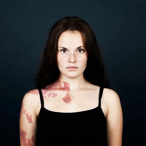 19 Portraits Of People With Birthmarks That Might Change The Way You ...