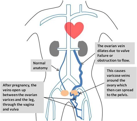 You've Been Diagnosed With Pelvic Congestion Syndrome... What Now?