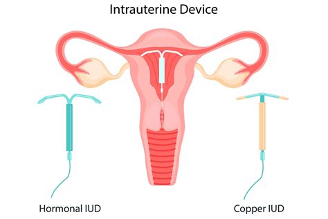 IUD Or Intrauterine Device: Everything To Know About The Contraceptive Coil IUD Including Side ...