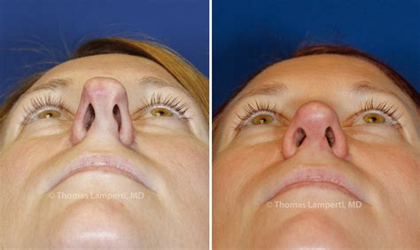 Asymmetric Nostrils | Rhinoplasty in Seattle