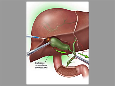 The gallery for --> Laparoscopic Cholecystectomy Anatomy