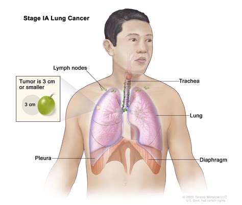 Non-Small Cell Lung Cancer Treatment (PDQ®) - NCI