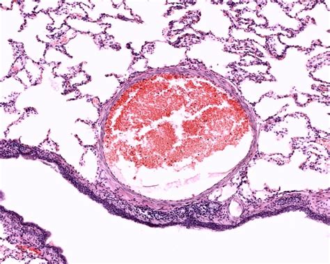 Pulmonary HTN