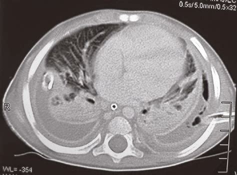 Medical Treatment Pictures-for Better Understanding: Empyema Drainage ...