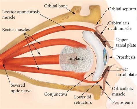 Socket anatomy - New Zealand Prosthetic Eye Service