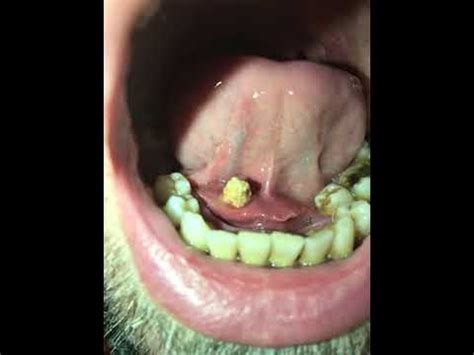 HUGE Salivary Gland Stone popping out - YouTube