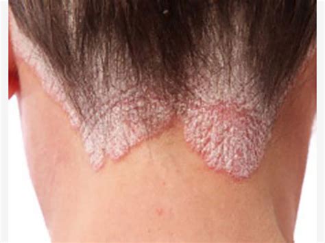 Eczema In Pictures(Mild To Severe Eczema) - Eczema Living