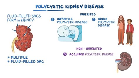 Polycystic kidney disease (PKD): Nursing - Osmosis Video Library