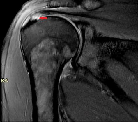 Supraspinatus Tear Mri