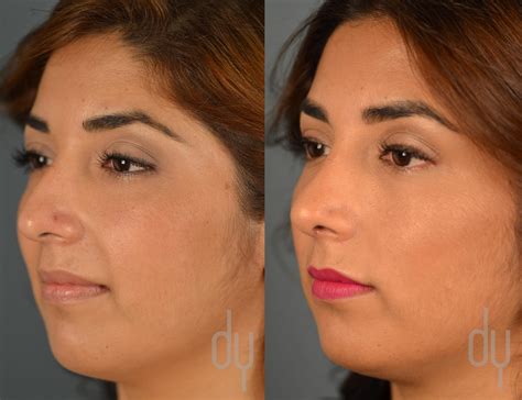 Rhinoplasty | Nose Job Recovery with Rhinoplasty Specialist Dr. Donald B. Yoo