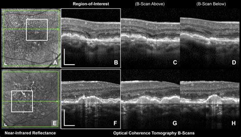 OCT Signs of Early Atrophy in Age-Related Macular Degeneration ...