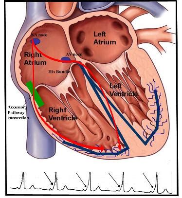 Treatment for Wolff-Parkinson White Syndrome (WPW) and Atrioventricular ...