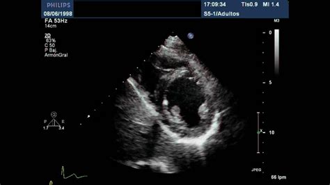 Exceptional presentation of a knife wound | Revista Española de Cardiología