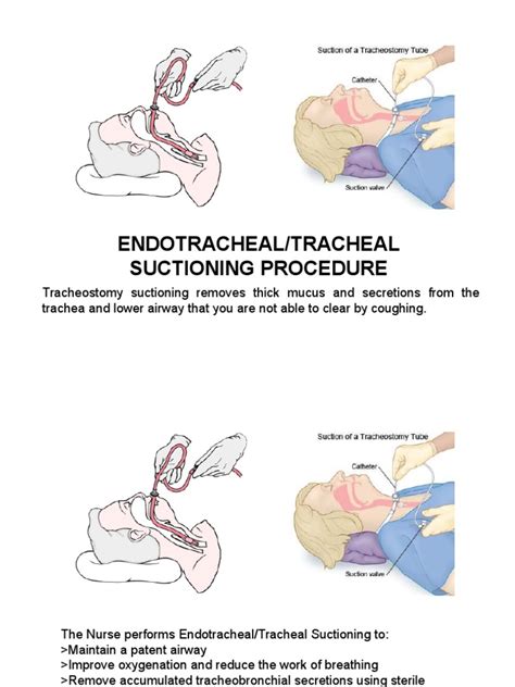 Endotracheal Suctioning Procedure | Clinical Medicine | Respiratory System