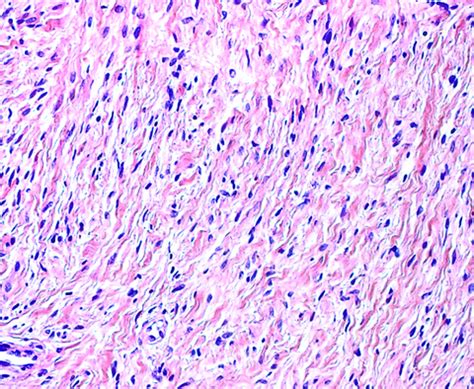 Pathology Outlines - Fibromatosis